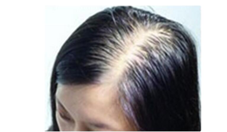女性脱发严重是什么原因引起的？女性脱发的原因和治疗