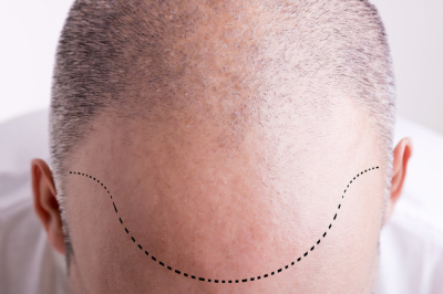女性脂溢性脱发到底能不能治愈,很多人植发两三年基本脱落了