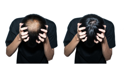 掉头发图片 掉头发严重是什么原因男性15岁