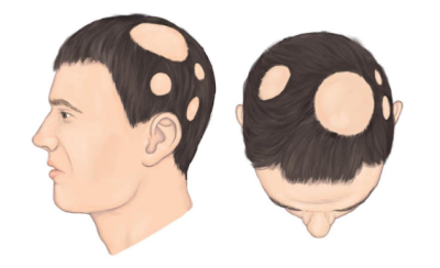 内分泌失调导致斑秃怎么调节,为什么头发一沾水就掉发严重