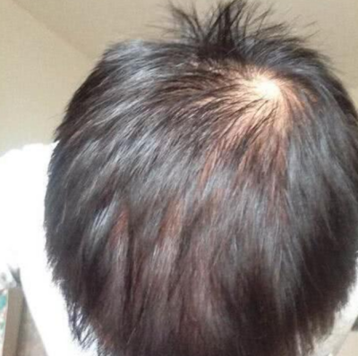 脂溢性脱发可以植发吗,脂溢性脱发可以自愈吗