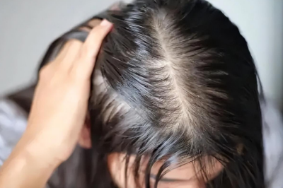 头皮油性大导致的脱发咋样治   脱发缺乏哪种维生素
